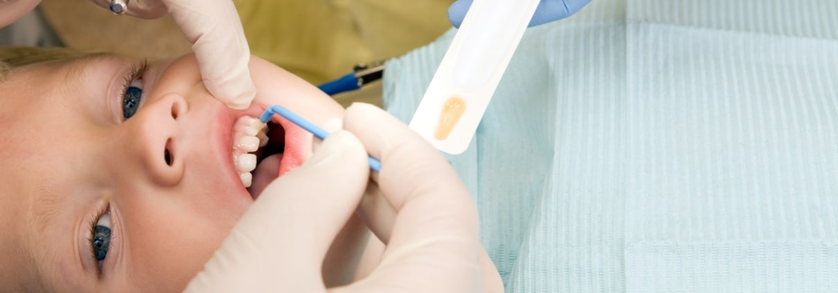 A child lies in a dental chair while a dentist applies fluoride treatment to their teeth using a small brush.