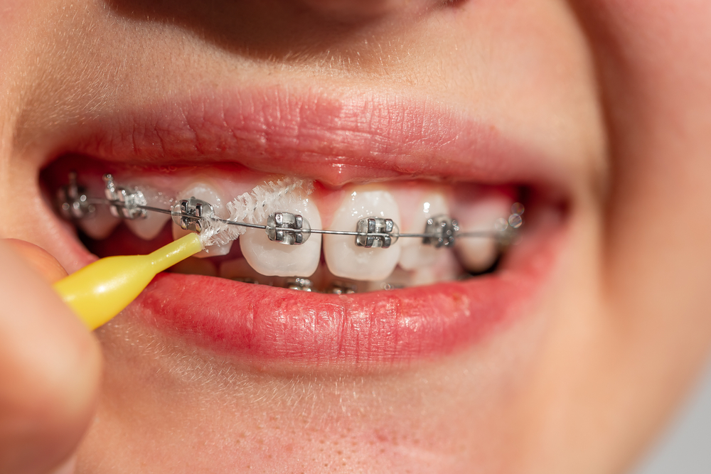 How Long Will My Child Need Braces?